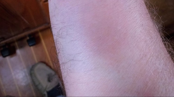 Swollen Wrist. Spider bite??